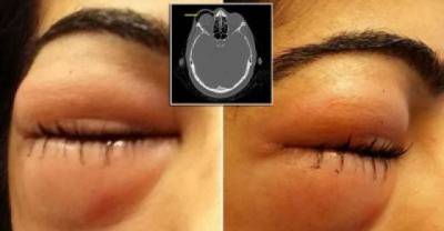 This Woman's Eye Swelled Exactly To The Size Of Golf Ball. When You See Why It Will Shock You!