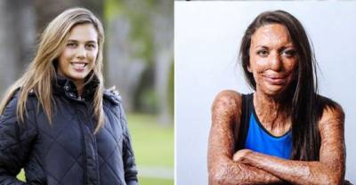 When Her Body Burned In A Fire, People Asked If He Still Loved Her. His Response Is Stunning