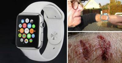 Horrifying! This Is What Wearing An Apple iWATCH Did To This Man!