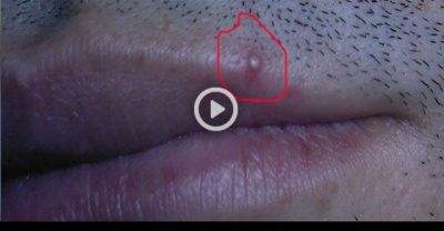 Girlfriend Squeezes Her Boyfriends Blackhead And It Just Keeps Coming.
