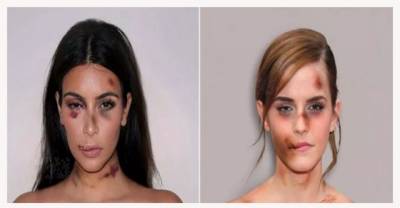 Bruised And Battered Images Of Pregnant Kim Kardashian And Other Celebrities Have Gone Viral. Here Is Why