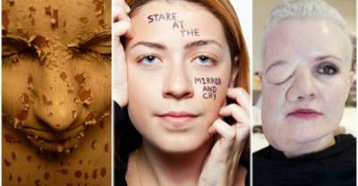 The Horror Of "Body Dysmorphic Disorder" The Disease That Melts The Skin