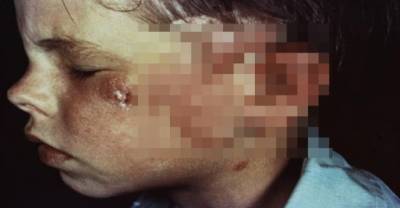 The 10 Grossest Things That Can Grow On Your Body