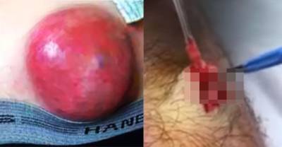 Omg! Doctor Thought It Was Just A Sebaceous Cyst, But It Wasn't!