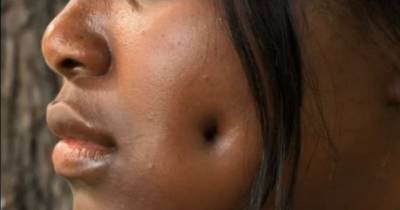 Woman&rsquo;s Face Deformed After Getting Fake Dimple Procedure.