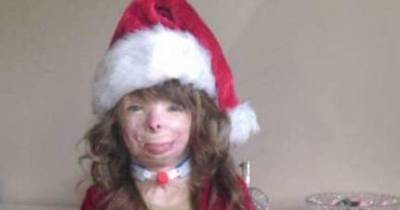 Young Burn Victim Who Lost Her Family Gets Hundreds Of Christmas Cards
