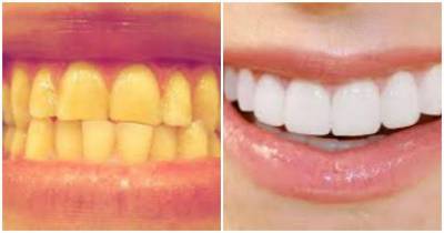 This Is How You Can Get Sparkling White Teeth In Just Two Minutes