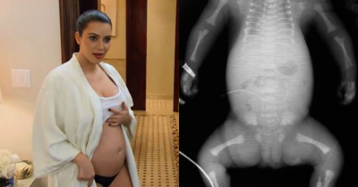 Kim Kardashian's Second Pregnancy Complication Is Way More Dangerous Than The First One