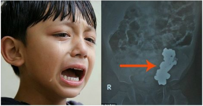 X-Ray Shocks Doctors After Child Complains Of Agonizing Stomach Pain
