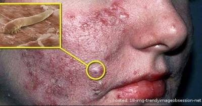 You'll Definitely Rush For A Mirror After Reading What They Discovered Living On Her Face