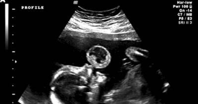 Doctors See A Baby "Blowing A Bubble" In Ultrasound. What It Turns Out To Be? Unbelievable