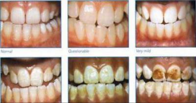 US Government Admits Americans Have Been Overdosed on Fluoride