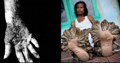 13 Rare Diseases You Never Knew That Existed!
