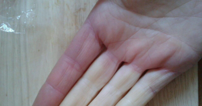 10 Things Only People With Raynaud&rsquo;s Will Understand