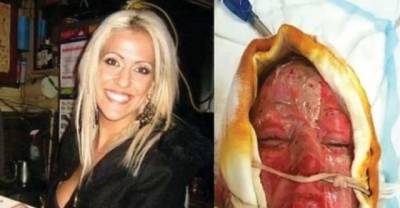A Woman Was Burned By A Maniac, After Two Years She Removed The Mask Protecting Her Face
