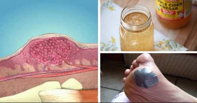 The Ultimate Guide For Removing Warts, Dark Spots, Blackheads And Skin Tags