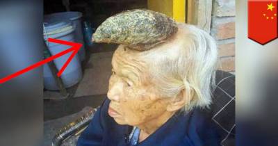 'Unicorn Woman' Set To Have 'Horn' Removed From Head After 13cm Spike Stops OAP Sleeping