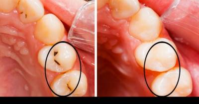 Amazing New Paste From Japan Heals Cavities Without Drilling