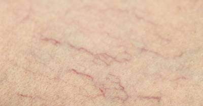 Everyone Has This Miracle Cure For Spider Veins At Home, But Not Many Know About It.