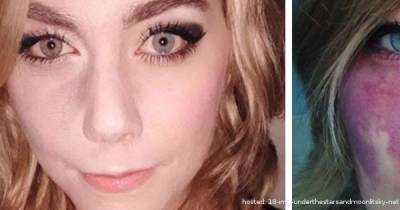 This Woman Proudly Shows Off Her Birthmark After Years Of Hiding