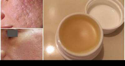 This Simple DIY Homemade Cream Will Get Rid Of Scars Completely Within 2 Weeks!