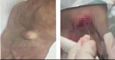 Doctor Slices Open Mystery Lump On Man's Foot And Is Stunned By What Is Inside