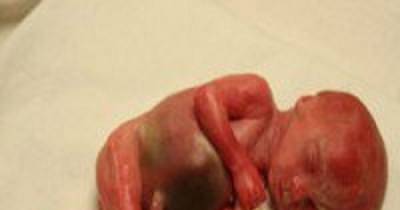 A Woman Found Out Her 22-Week-Old Baby Was Born A Day After An Abortion!