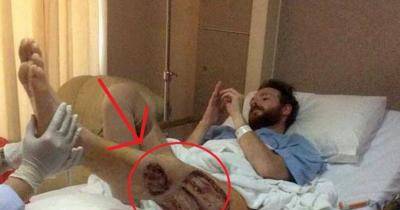 Bug Almost Ate Away Backpacker's Leg While He Was On Vacation With Girlfriend