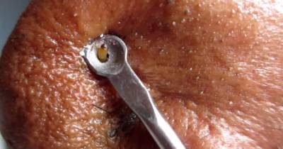 Doctor Removes Blackheads Covering Man's Nose Built Up Over Many Years