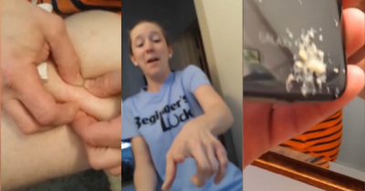 Stomach Churning, Man Pops 30-year-old Spot That Bursts All Over His Disgusted Wife