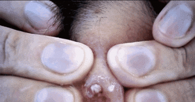 This Is What Popping A 20-Year-Old Zit Looks Like