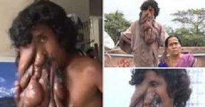 'Elephant Man' With 'trunk' Due To Rare Condition Is Revered As God But Needs Miracle Surgery