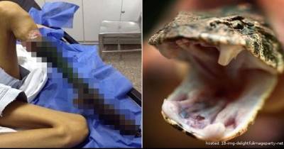 This 13-Year-Old Girl's Leg Shrivels And Rots Due To Snakebite