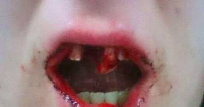 A Domestic Violence Victim Is Struggling To Pay A &pound;6k Dental Bill To Replace Teeth That Her Jealous Ex-Boyfriend Punched Out During A Malicious Revenge Assault.