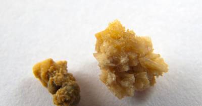 13 Unknown Warning Signs That You&rsquo;ll Get Kidney Stones (And How To Prevent Them)