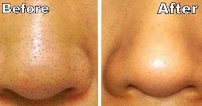 Girl Removed Her Blackheads With These Easy and Effective Steps, Brilliant!