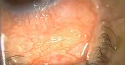 Terrifying: 20 Cm Long Worm In The Human Eye, First Ever Recorded On Video