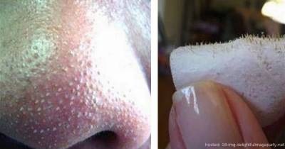 You'll Never Worry About Your Gross And Annoying Blackheads After THIS!