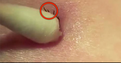 Watch Her Remove This Tick With A Cotton Swab. It's Really Easy To Do.