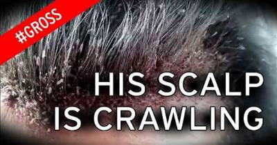 You Won't Believe What This Man Had Crawling On His Head and Neck..