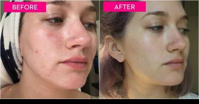 All It Takes To Get Rid Of Acne Is To Keep Your Hands To Yourself! A 7 Day Experiment That Really Made Its Point