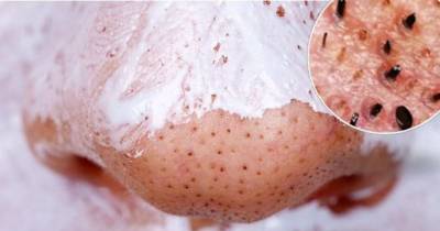 This One Easy Trick Can Get Rid Of All Those Annoying And Gross Blackheads Instantly!