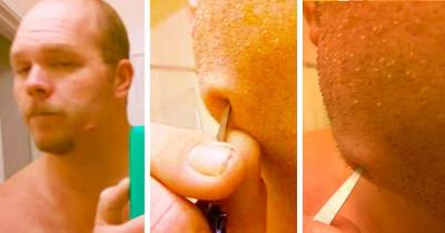Man Pops His Huge Tooth Abscess With Scissors In Disgustingly Gruesome