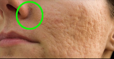 Make UNSIGHTLY Pores Disappear In An Instant With One Simple Home Ingredient!