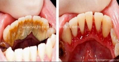 Here Are Tricks To Remove Tartar Buildup At Home