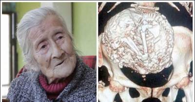 91 Year Old Woman Is Pregnant With 60 Year Old Fetus