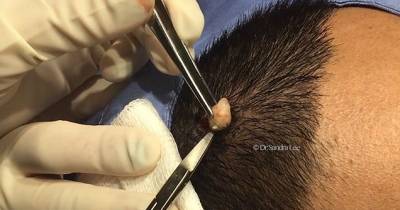Man Has Huge 'Horn-like' Cyst Cut Out Of His Head - And What Is Hidden Beneath Is Truly Gruesome