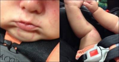 She Picked Her Son Up From Day Care And Noticed This On His Body, Shocking!
