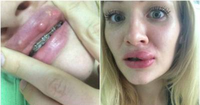 Woman&rsquo;s Kylie Jenner Lip Treatment Went Horribly Wrong