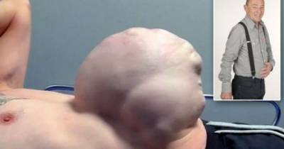 Man With Football-Sized Tumour Bursting Out Of Stomach